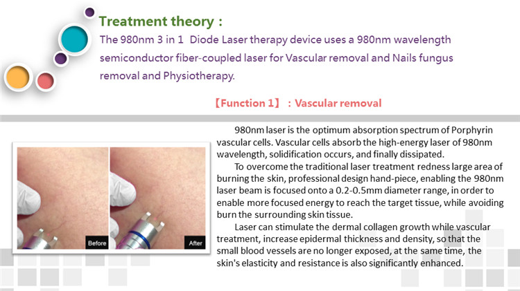 980NM Vascular Removal Machine