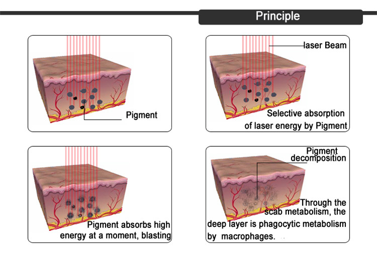 Q Switched ND YAG Laser